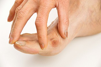 Understanding Bunions