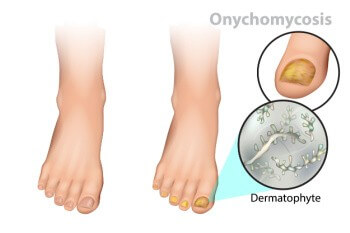 All About Fungal Toenail Infections